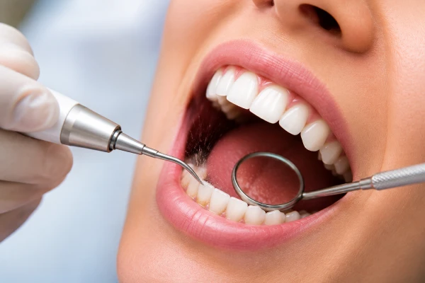 Scaling & Teeth Cleaning Scaling & Teeth Cleaning
