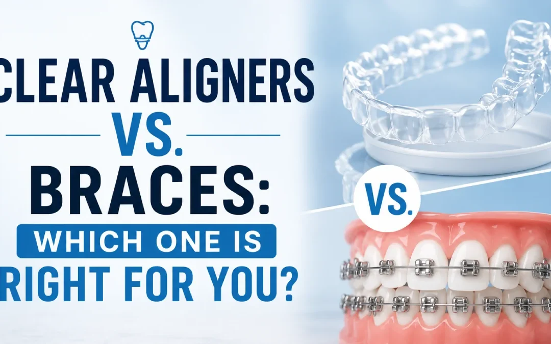 clear aligners