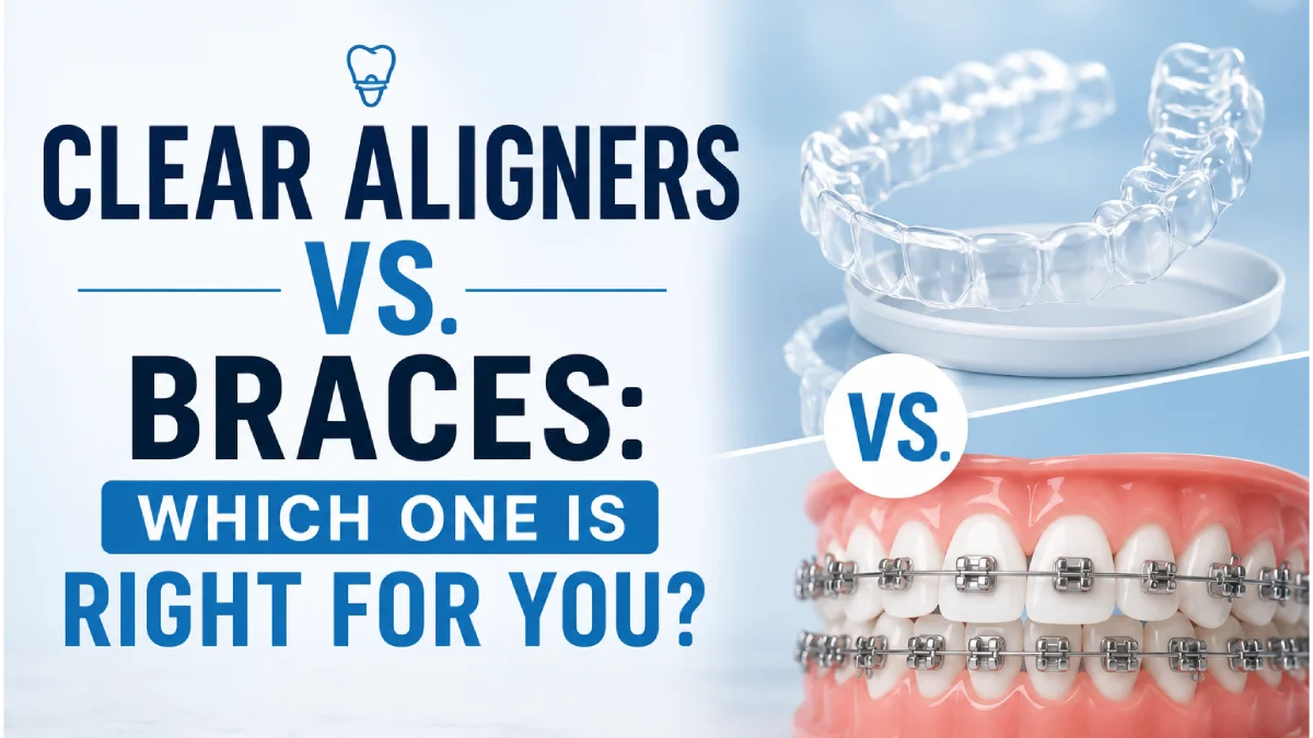 Clear Aligners vs. Braces: Which One Is Right for You?