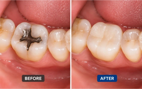 dental filling