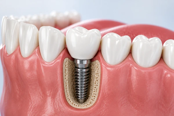 Dental Implant